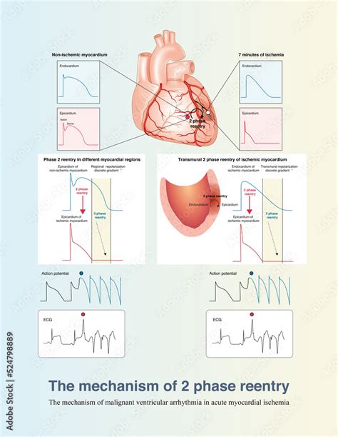 association between myocardial mechanism and ischemic lv remmodeling tradotto|Ischemic Left Ventricular Dysfunction: Severity of Remodeling .